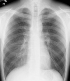 胸部X線画像