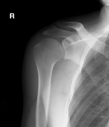 肩関節X線画像