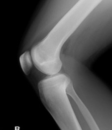 膝関節X線画像