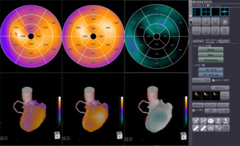 ワークステーションによる解析冠動脈CTと⼼筋シンチグラフィのfusion画像
