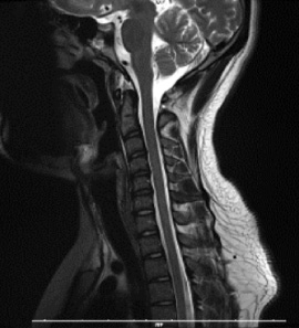 頸部MRI